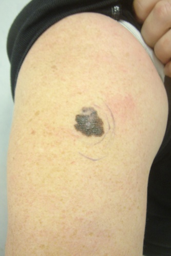 melanoma